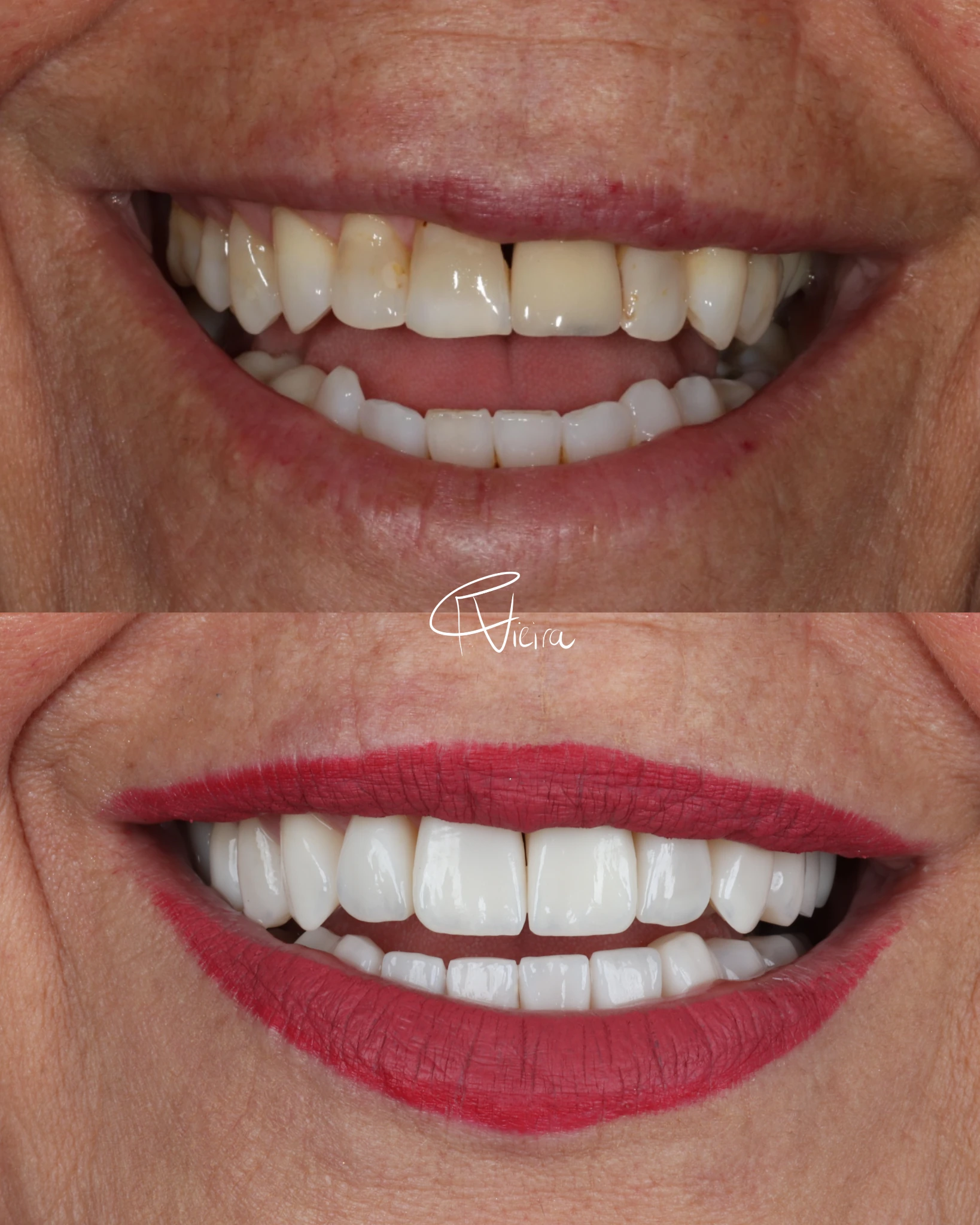 Dental before-and-after case focused on smile aesthetics and harmony, published by the practice.