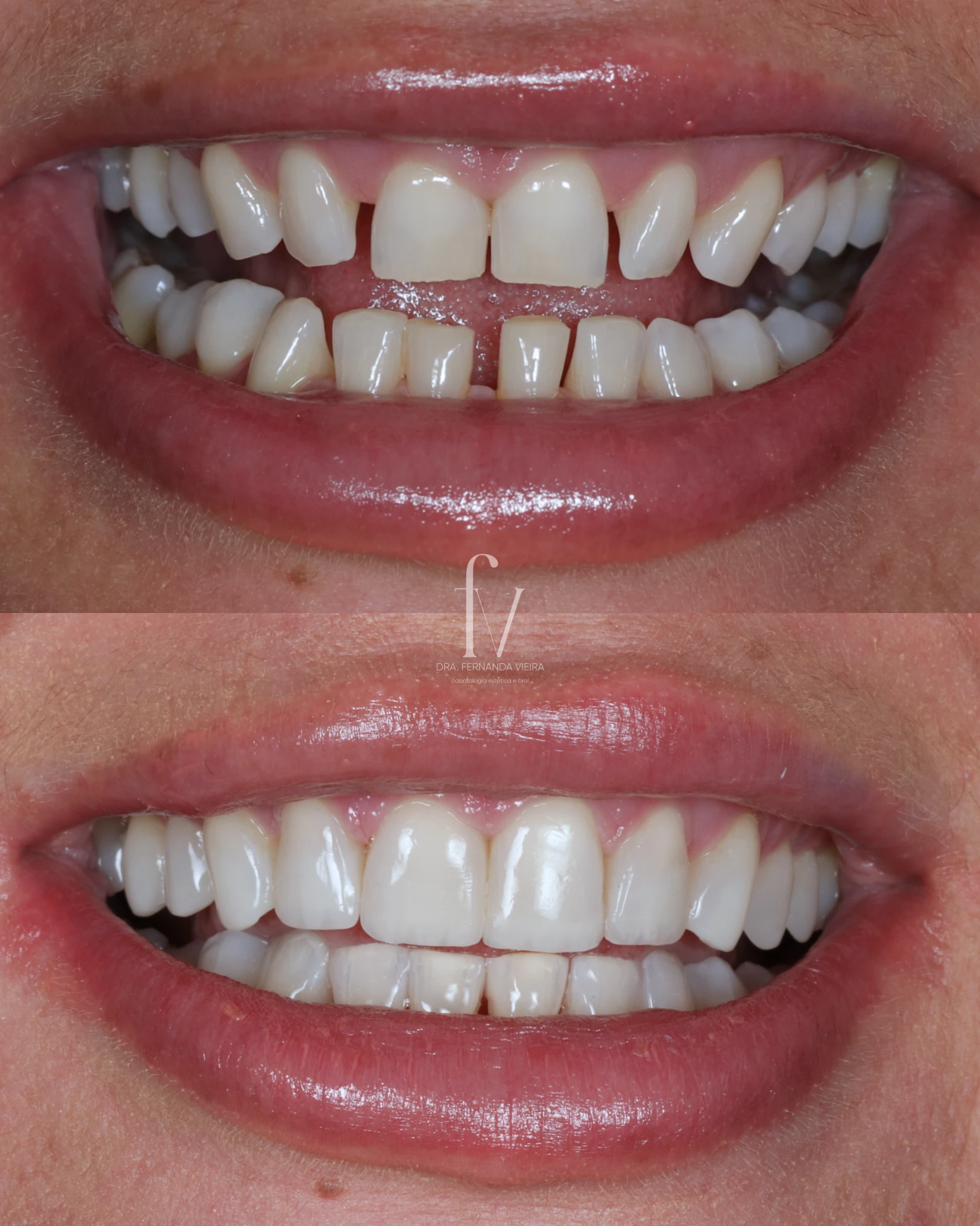 Before-and-after smile comparison from dental treatment published by the practice.