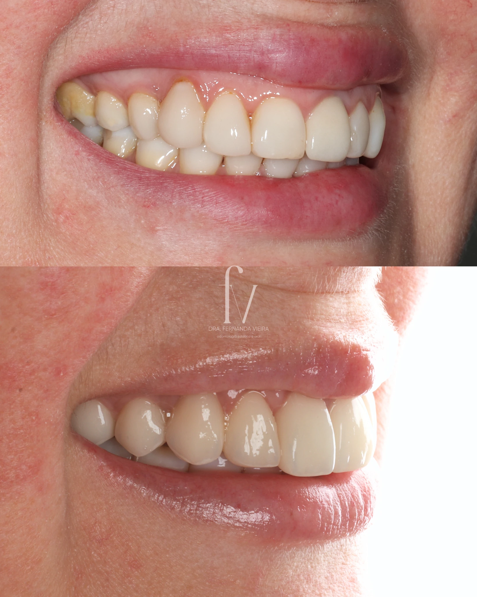 Before-and-after images from a cosmetic smile rehabilitation case published by the practice.