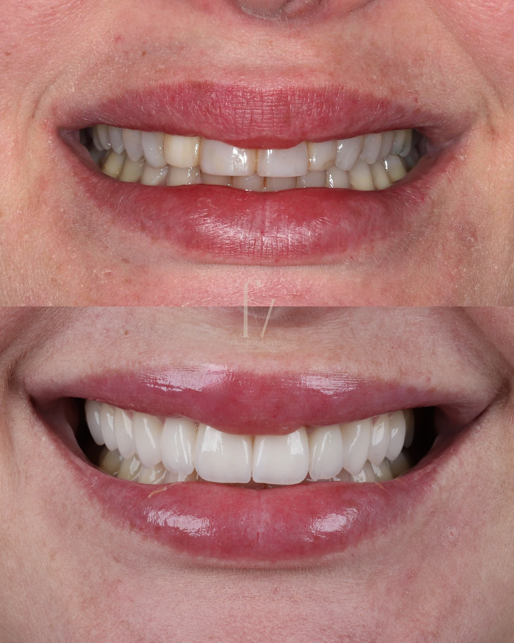 Before-and-after smile comparison from a clinical case published by Fernanda Vieira Odontologia.