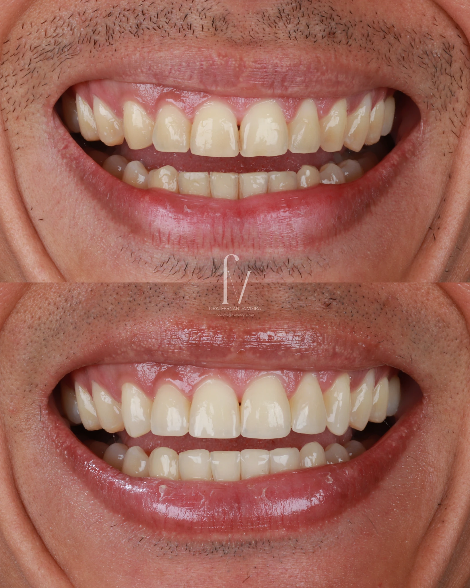 Smile photographed before and after dental treatment in a case published by the practice.