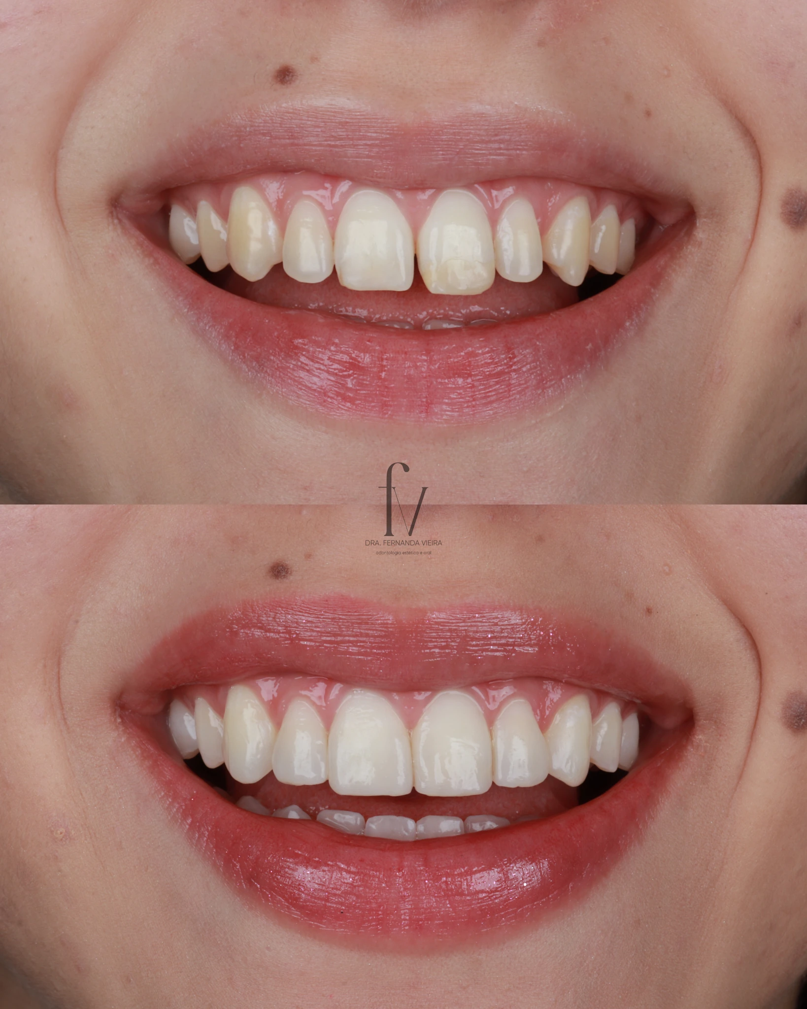 Before-and-after images from a dental case showing an aesthetic smile result, published by the practice.